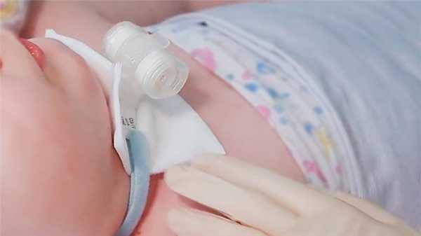 Трахеостома у детей