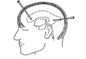 пункция головного мозга