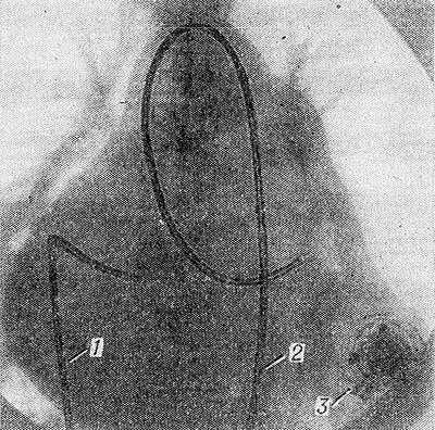 Рентгенограмма сердца с введенными в его полости катетерами (одновременная катетеризация правых и левых отделов сердца): 1 — катетер через бедренную и нижнюю полую вены проведен в правый желудочек; 2 — катетер через бедренную артерию и аорту проведен в левый желудочек; 3 — фонографический датчик (прикреплен снаружи к грудной стенке).