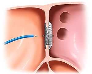 Эндоваскулярное закрытие дефекта межпредсердной перегородки