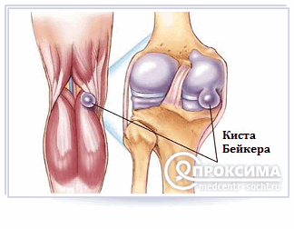 Киста Бейкера