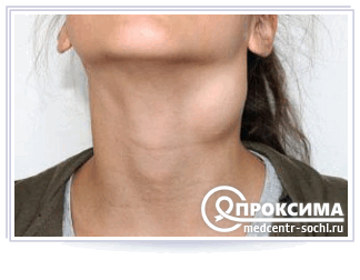 Бронхиальная киста шеи