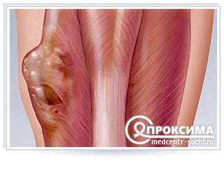 Синовиальные кисты