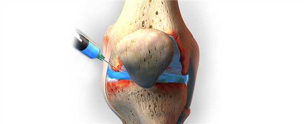 Схема проведение артроцентеза коленного сустава