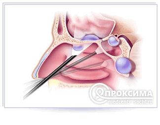 Пункция кисты
