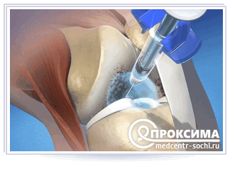 Лечебные пункции