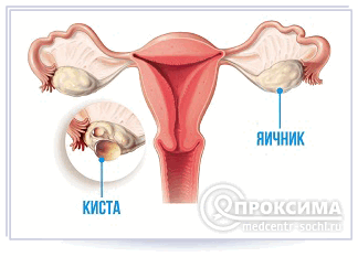 Киста яичника