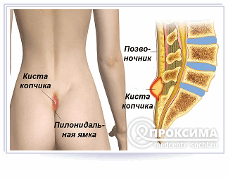 Копчиковая киста