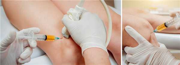 Проведение процедуры откачивания жидкости из колена