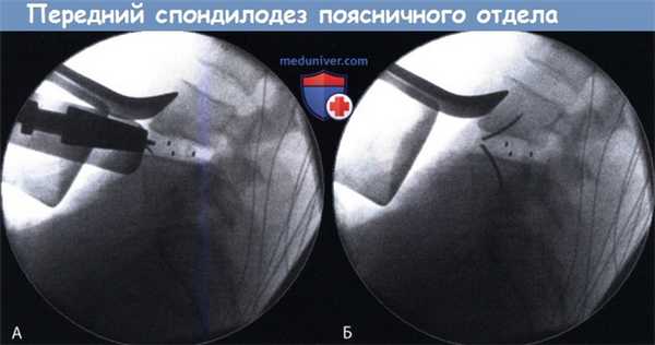 Передний спондилодез поясничного отдела позвоночника