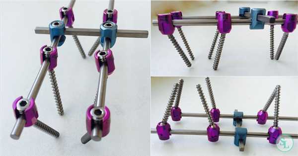 Транспедикулярная фиксация позвоночника - консутрукция