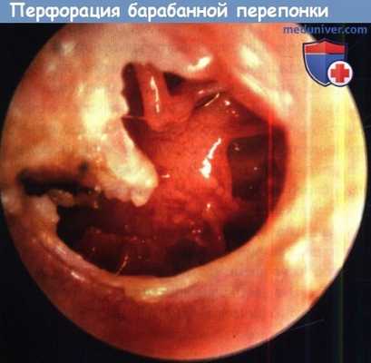 Перфорация левой барабанной перепонки