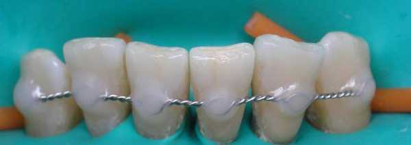 шинирование нижних зубов