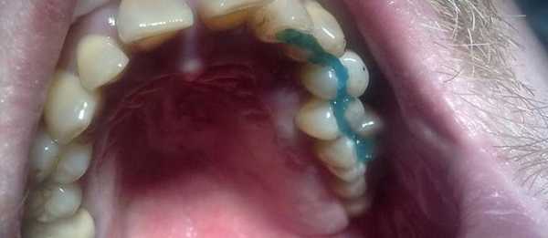 шинирование при пародонтите