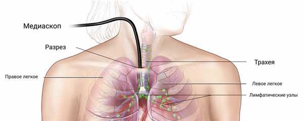 Медиастиноскопия