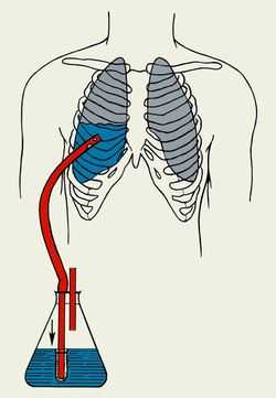 Отсасывающий дренаж из плевральной полости