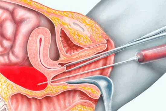 Лапароцентез: значение процедуры в диагностике и лечении патологий брюшной полости