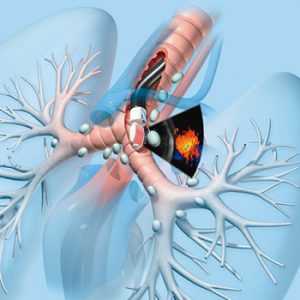 Проведение бронхоскопии