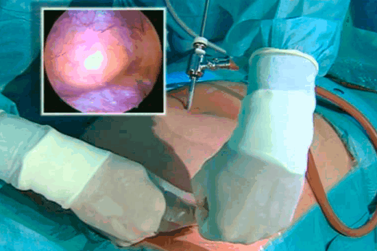 Лапароцентез: значение процедуры в диагностике и лечении патологий брюшной полости