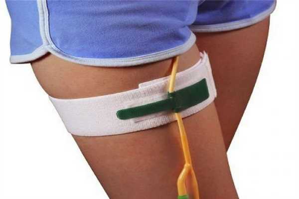 Фиксация катетера
