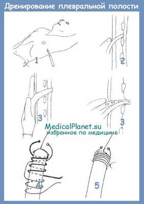 дренирование плевральной полости