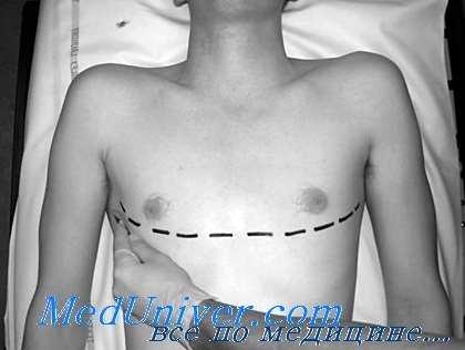 Лондонский доступ при экстренной торакотомии