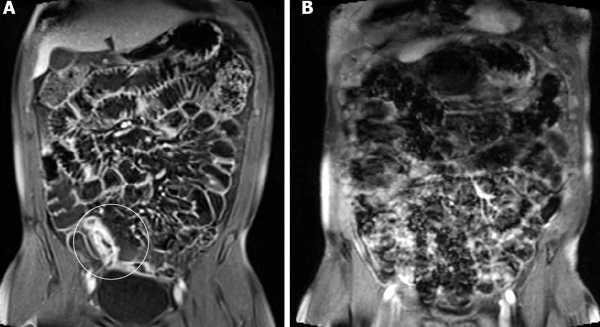 МРТ кишечника: что показывает