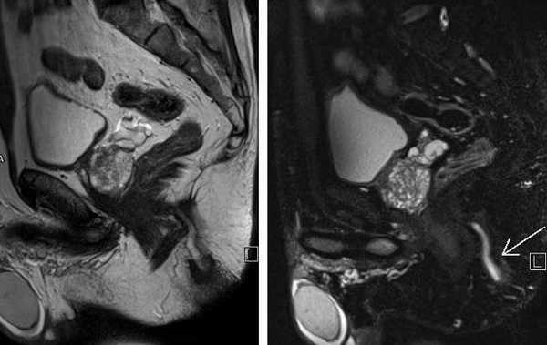 МРТ малого таза в сагиттальной плоскости