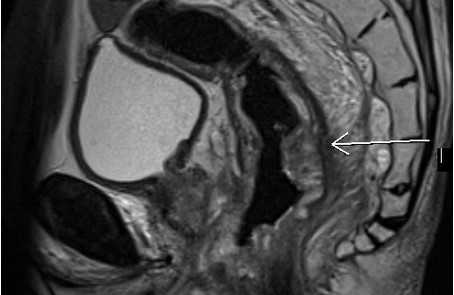 МРТ малого таза в сагиттальной плоскости