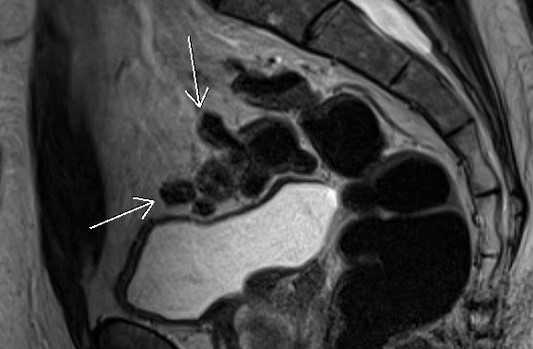 МРТ малого таза в сагиттальной плоскости
