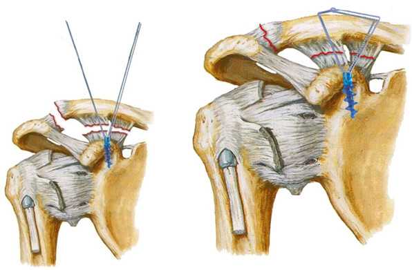 Использование якорных фиксаторов, нити которых повторяют ход связок