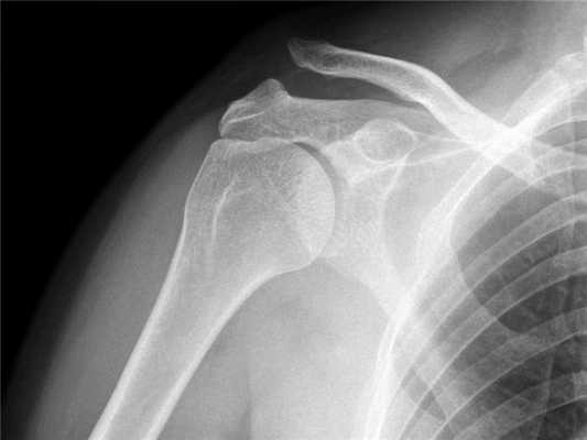 Рентгенография — диагностика при вывихе акромиального конца ключицы