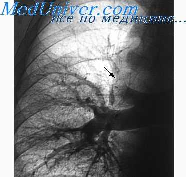 зондирование сердца