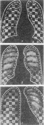 Двухфазные рентгенопневмополиграммы в норме (а), при эмфиземе легких (б) и в начальной стадии нарушения проходимости верхнедолевого бронха левого легкого вследствие развития опухоли (в): а — равномерное чередование более темных квадратов, отражающих плотность легочной ткани на выдохе, и более светлых — на вдохе (изображение позитивное); б — различия в оптической плотности квадратов, соответствующих фазам вдоха и выдоха, резко уменьшены по сравнению с нормой, снижена подвижность диафрагмы и ребер; в — полная нивелировка оптической плотности квадратов в области верхней доли левого легкого. Сплошной линией обозначены контуры средостения и диафрагмы на вдохе, пунктиром — на выдохе.