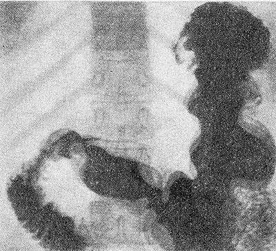 Полиграмма (триплограмма) желудка в норме: видны три контура желудка, отражающих его перистальтические сокращения.