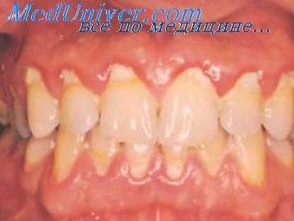 зубные бляшки и пцр