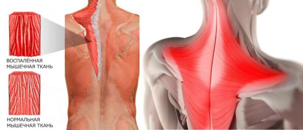 Полимиозит