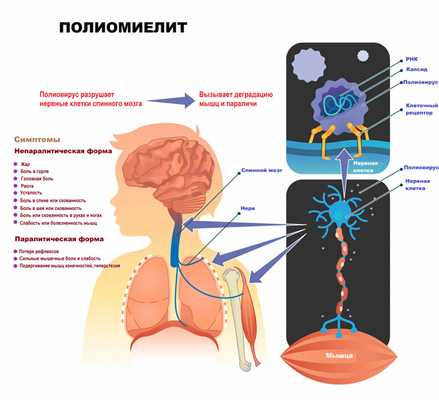 Полиомиелит.jpg
