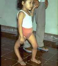 Полиомиелит