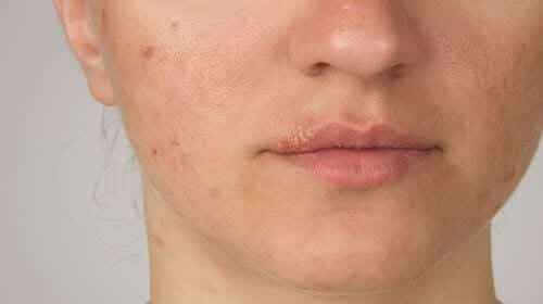 Герпетические высыпания на лице