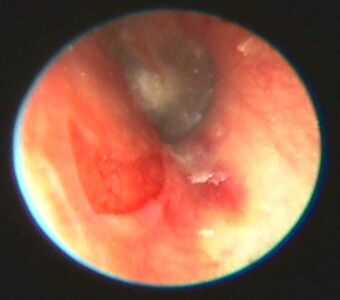 6 день лечения