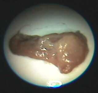 полип после 6 дня