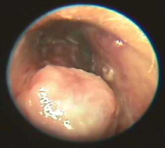 После 1 дня лечения