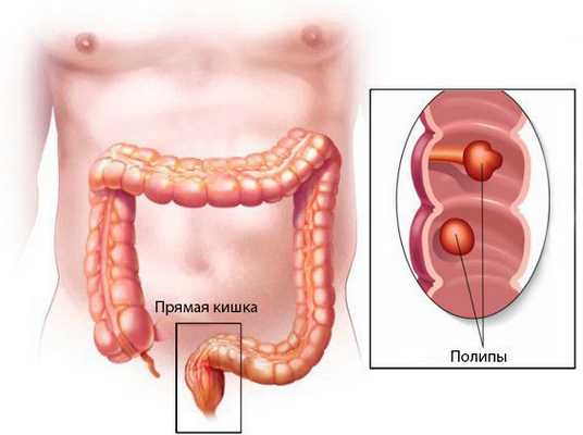 Полипы прямой кишки