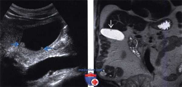 УЗИ, МРТ желчного пузыря при холестериновом полипе