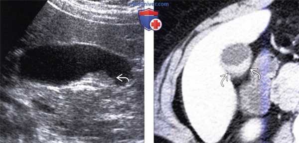 КТ, УЗИ признаки полипа желчного пузыря