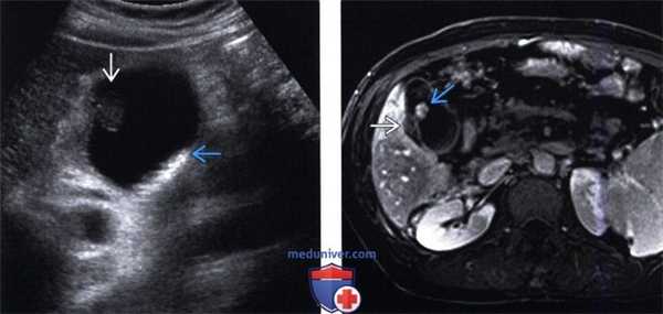 УЗИ, МРТ желчного пузыря при холестериновом полипе