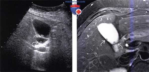 КТ, УЗИ признаки полипа желчного пузыря