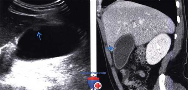 УЗИ, КТ желчного пузыря при холестериновом полипе