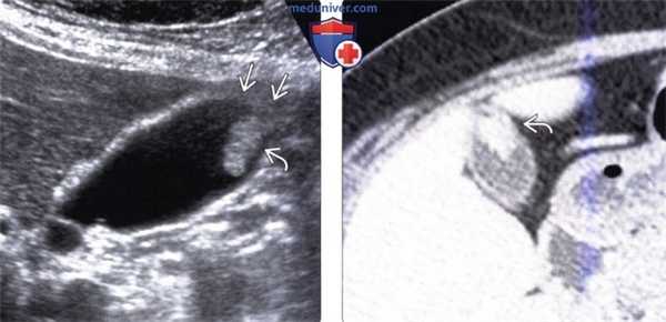 КТ, УЗИ признаки полипа желчного пузыря